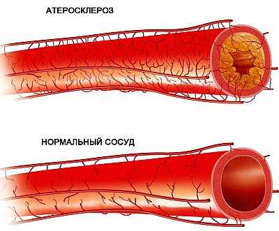 Атеросклероз брюшного. Облитерирующий атеросклероз сосудов ног. Облитерирующий атеросклероз брюшной аорты. Атеросклероз брюшного отдела аорты. Облитерирующий атеросклероз артерий ног.