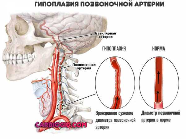 Гипоплазия правой позвоночной артерии что это такое