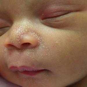 У новорожденного на носу белые точки что это такое